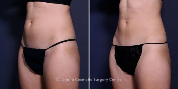 Abdomen CoolSculpting before and after of a La Jolla patient.