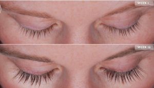Before-and-after-latisse-for-eyelash-growth-longer-thicker-darker