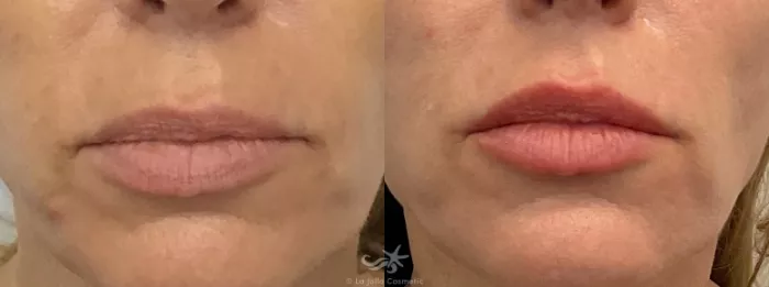 before and after lip filler