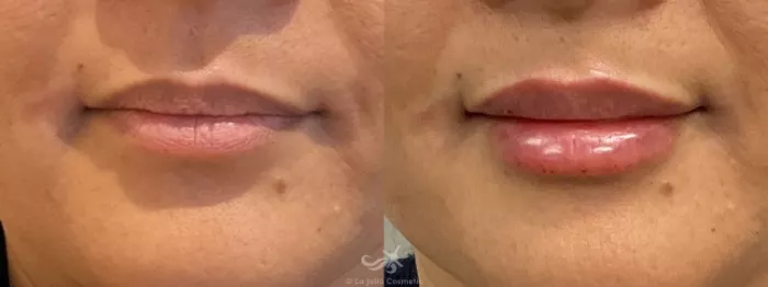 before and after lip filler