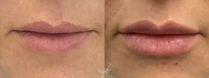 before and after lip filler