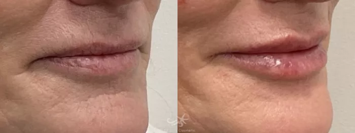 before and after lip filler