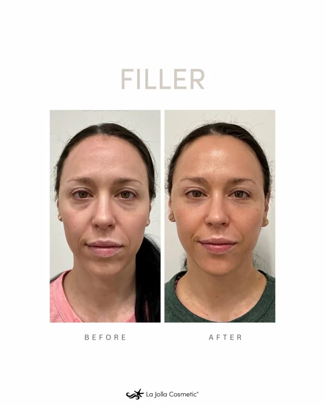 Filler is magical 🪄 ✨ Achieving natural and undetectable results is possible! Look refreshed and feel your most confident. Book your consultation today!