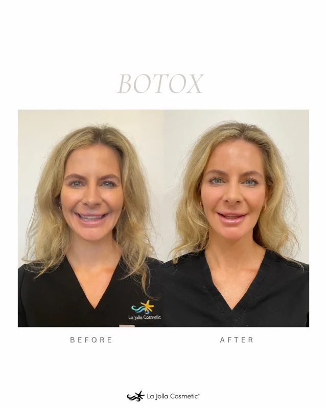 ✨ Trust your face to the experts ✨ ⁠La Jolla Cosmetic is in the top 1% in the country for Botox® & Fillers.⁠
⁠
Precise, professional, and always tailored to you. When it comes to Botox, experience matters. Choosing a medical professional who understands both the science and the art of aesthetics. ⁠
⁠
First-time patients receive Botox at $10/unit (40 unit minimum)⁠
⁠
Ready to elevate your glow? Book your consultation today and experience the difference expert care makes. ⁠
⁠
