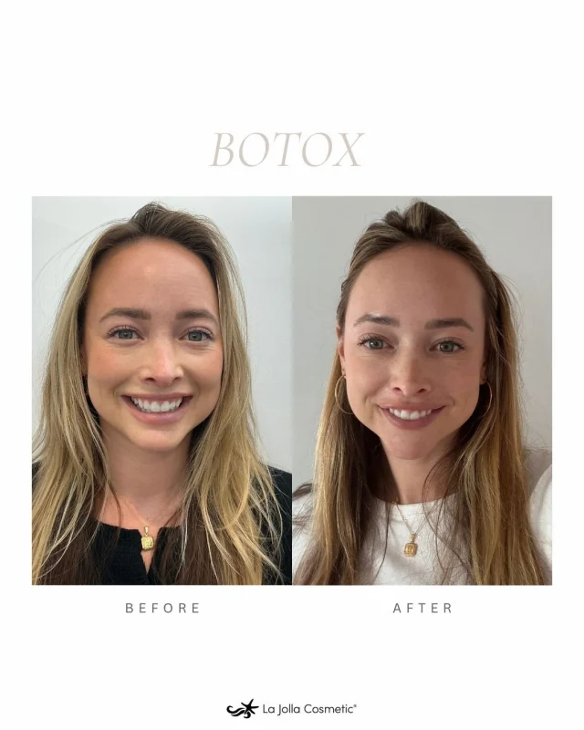 💉 Confidence starts with expertise 💉⁠
⁠
La Jolla Cosmetic is proud to be in the top 1% nationwide for Botox® & Fillers.⁠
⁠
Dr. Kathy Baldwin delivered beautiful, natural results for her patient—treating the forehead, crow’s feet, and masseter for facial balancing that still looks like you.⁠
⁠
✨ First-time Botox? Just $10/unit (40-unit minimum) ✨⁠
⁠
Glow with confidence—book your consultation with Dr. Baldwin at our La Jolla location today!