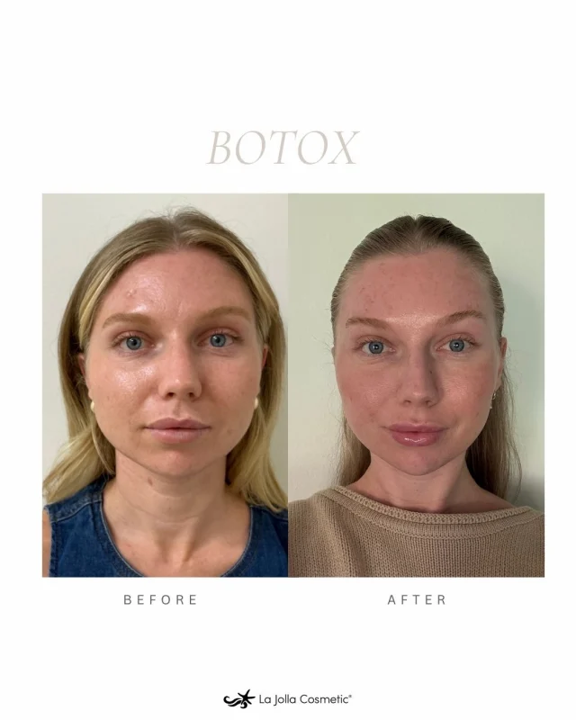These beautiful results done by Liz, at our new Temecula location, includes treatment of the forehead, crow’s feet, masseter, and platysmal bands—creating a slim, natural facial harmony without looking overdone.⁠
⁠
Our new patient botox special is just $10/unit (40-unit minimum) !⁠
⁠
Book your complimentary consultation with Liz in Temecula today!