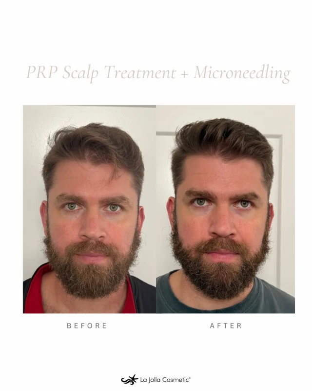 Stronger hair starts at the root. 🌱 Our PRP Scalp Treatment with Microneedling is a non-surgical solution designed to stimulate natural hair growth using your body’s own growth factors.⁠
⁠
By combining platelet-rich plasma with microneedling, we encourage collagen production, increase blood flow, and reactivate weakened follicles. The result? Healthier, denser, more confident hair. ⁠
⁠
Ready to take the next step? Call us to schedule your complimentary consultation.