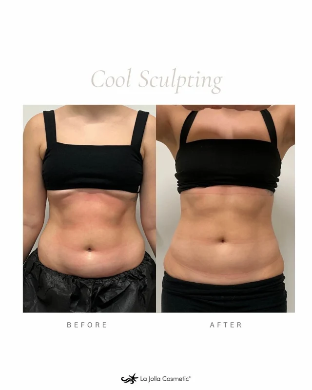The power of CoolSculpting lies in its science. Using controlled cooling, it safely targets and freezes stubborn fat cells that diet and exercise just can’t seem to touch. ❄️ Over time, your body naturally eliminates these cells, leaving behind a more sculpted, confident you.⁠
⁠
No surgery. No downtime. Just results that empower you to feel your best. ⁠
⁠
Book your complimentary consultation today at La Jolla Cosmetic Medspa and let us help you reach your dream goals!