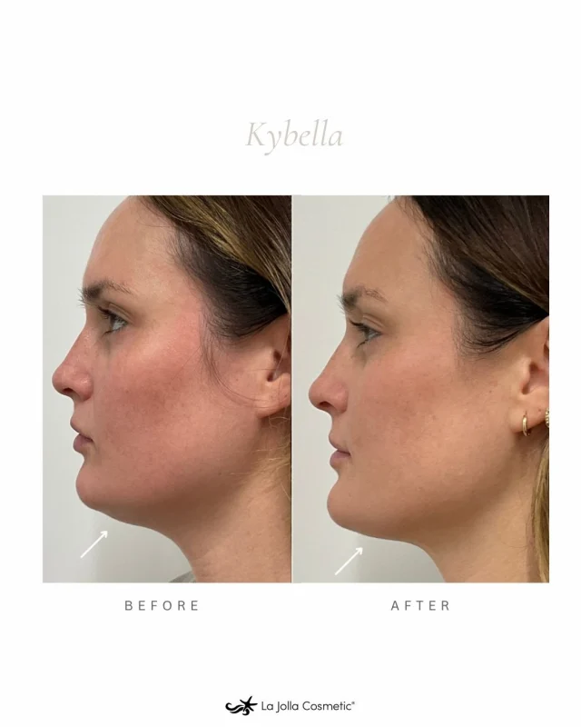 Smooth, sculpted, and defined — that’s the power of Kybella®. ⁠
⁠
This FDA-approved injectable treatment targets and eliminates fat beneath the chin for permanent, natural-looking results.⁠
⁠
⁠
Ready to love your profile from every angle? Call to book your complimentary consultation today! ✨