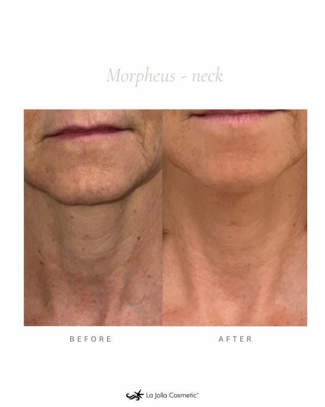 Goodbye crepey skin, hello confidence. 💫⁠
⁠
Morpheus8 works below the surface to tighten, smooth, and rejuvenate your neck for a naturally lifted look.⁠
⁠
Book your consultation at La Jolla Cosmetic and love your profile from every angle! ✨