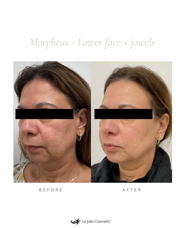 Lift. Tighten. Define. 💫⁠
⁠
Morpheus8 uses radiofrequency microneedling to firm the skin and contour the lower face—reducing jowls and restoring youthful definition along the jawline.⁠
⁠
✨ See the difference for yourself—book your consultation today at La Jolla Cosmetic!