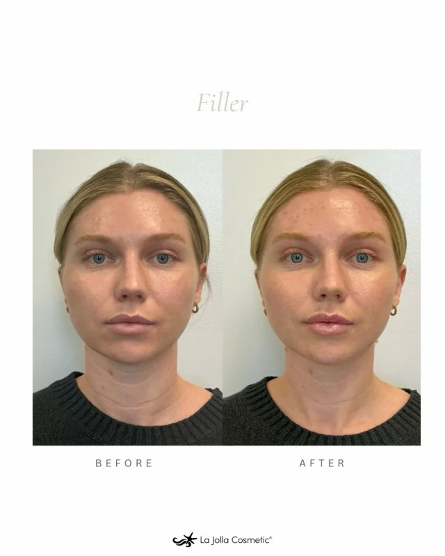 Thinking about getting filler? Consider this your sign! ✨⁠
⁠
A small, expertly placed amount of filler can make a big difference—enhancing balance, harmony, and your natural beauty. And because no two faces are the same, our skilled injectors tailor every consultation and treatment plan specifically to you. Your features, your goals, your look. Always.⁠
⁠
With providers who deeply understand facial anatomy and prioritize natural, personalized results, you’ll walk out looking like yourself… just refreshed.⁠
⁠
Call any of our four beautiful offices in Carlsbad, La Jolla, Temecula, or Otay Ranch to schedule your complimentary consultation today! 💫