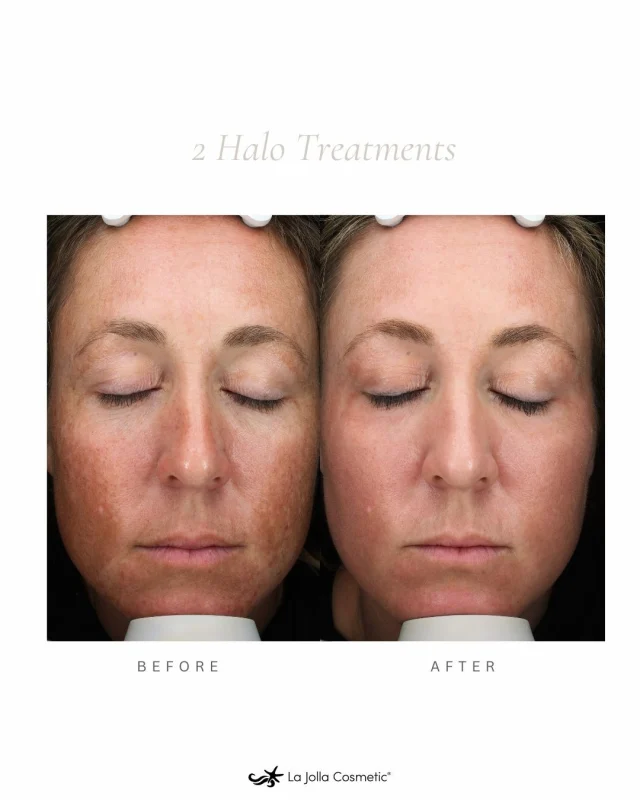 HALO laser treatments leave your skin feeling fresh, glowing, and like the best version of itself.⁠
⁠
At LJC, our board-certified experts take the time to understand your skin and customize every session around you—so your results feel natural and completely your own.⁠
⁠
Curious about what HALO could do for your skin? Let's talk—book a consultation with one of our experts today.