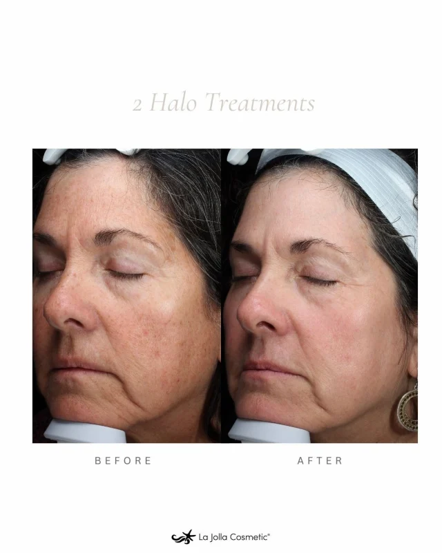 ✨ Transformative, natural, and beautifully radiant. ✨⁠
⁠
These results are from two Halo Laser treatments, revealing brighter tone, smoother texture, refined pores, and that healthy, luminous glow advanced resurfacing is known for.⁠
⁠
At LJC, our board-certified experts personalize every laser session with care and precision, selecting the right depth, settings, and treatment plan to refresh your skin while keeping your results looking naturally you. It’s where thoughtful technique meets beautiful, lasting results.⁠
⁠
Thinking about refreshing your skin? Call to schedule your consultation.
