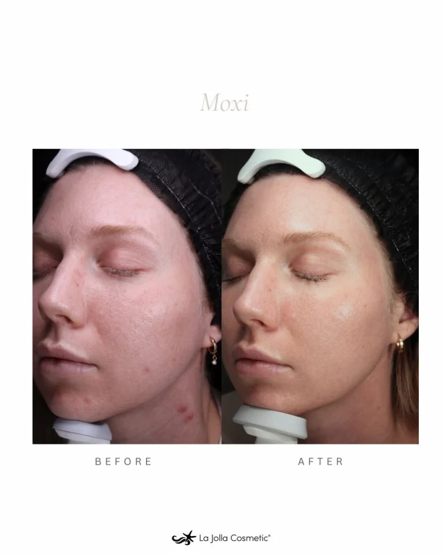 Bare-faced. No filter. No makeup.⁠
⁠
At 29, this patient chose MOXI to invest in real skin quality—because confidence isn’t about covering up, it’s about correction, prevention, and expert planning.⁠
⁠
MOXI is for refining texture, boosting tone, and supporting your skin long-term—so you feel confident stepping out bare-faced, any day of the week.⁠
⁠
Ready to see what treatments your skin needs? Call one of our four locations in La Jolla, Otay Ranch, Temecula, or Carlsbad!