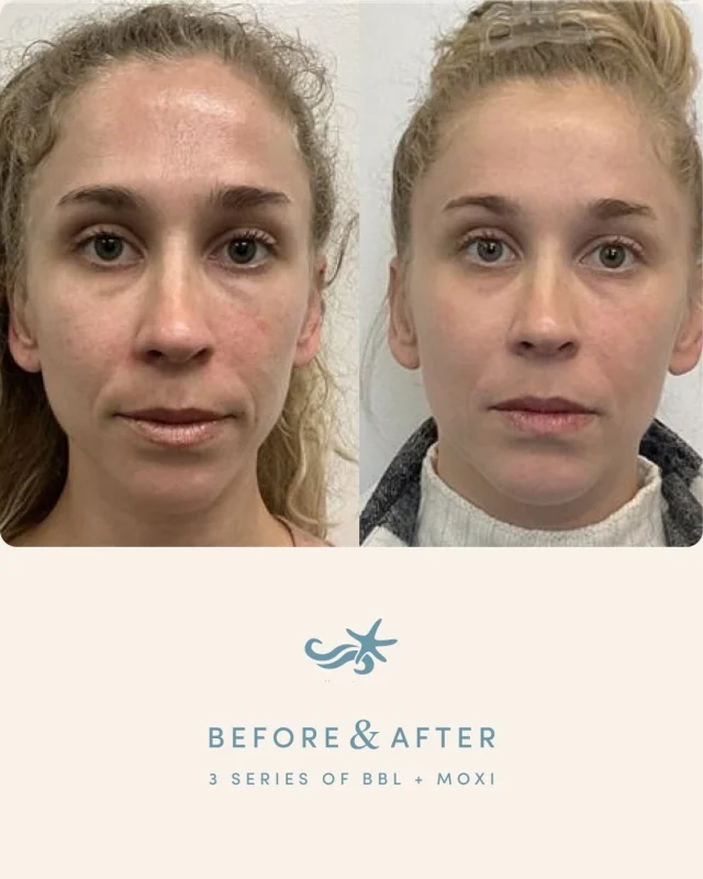 Real skin. Real progress. ✨

At 37, this beautiful patient wanted to address pigmentation and uneven texture. She completed a series of three BBL + MOXI treatments spaced 4–6 weeks apart, designed to correct existing damage while supporting long-term skin health. The transformation speaks for itself.

Consistency is key — committing to a treatment series is what allows results like this to truly shine.

Swipe to see the transformation and just how much pigment has been lifted. 🤍

Ready to create a plan for your skin? Call one of our locations in La Jolla, Otay Ranch, Temecula, or Carlsbad to schedule your consultation.
