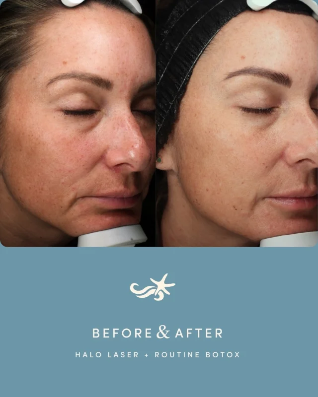 She came in ready for a change and wow, did her skin deliver. ✨

At 41, this patient was dealing with hyperpigmentation and uneven skin texture. Her provider performed a HALO laser treatment on her face, and the transformation is honestly stunning. We are talking the majority of her hyperpigmentation lifted and smoother, more radiant skin overall. 🤍

And the best part? She didn’t stop there. She has kept her glow going with a HALO every 1.5 years, regular Botox, and a solid skincare routine. That consistency is everything!

Ready to create a plan for your skin? Call one of our locations in La Jolla, Otay Ranch, Temecula, or Carlsbad to schedule your consultation.