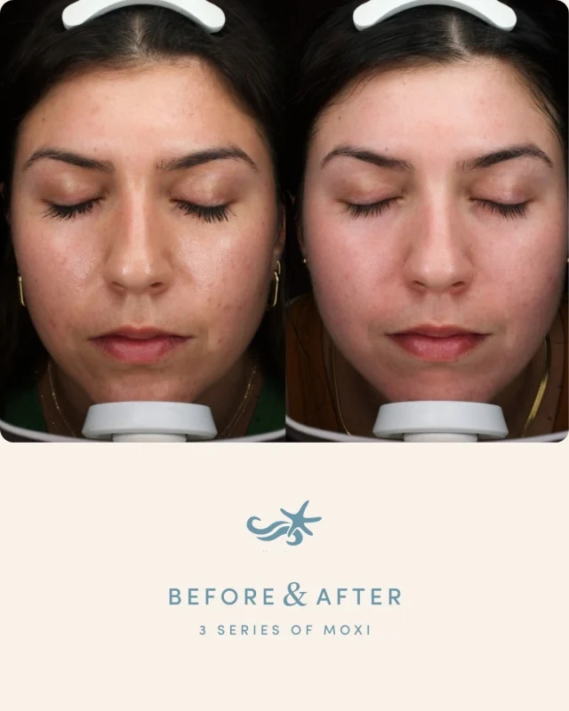 Less pigment. More confidence. 🤍

This 31-year-old patient wanted to improve hyperpigmentation from acne scarring. She completed a series of three MOXI treatments spaced 4–6 weeks apart.

Using the VISIA skin analysis technology, you can clearly see the difference — brighter skin tone and a noticeable improvement in underlying pigment.

She also pretreated with hydroquinone and stayed consistent with her skincare, helping maximize her results.

Ready to create a plan for your skin? Call one of our La Jolla, Otay Ranch, Temecula, or Carlsbad locations to schedule a consultation, or click the link in bio.