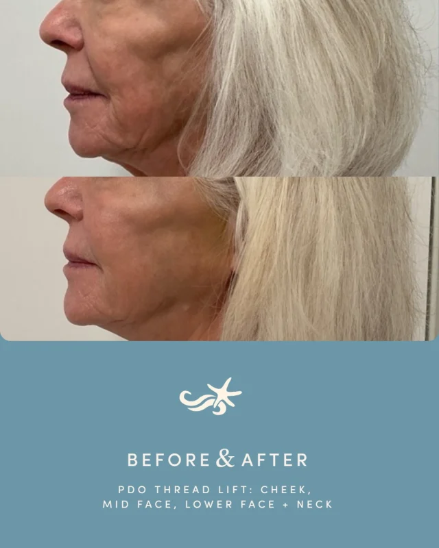 A little lift, a big difference 💫🪽

This 74-year-old patient wanted a more youthful appearance, with a focus on the neck and jowl area. Anna performed a PDO thread lift targeting the cheeks, mid face, lower face, and neck — creating a smoother, more lifted profile.

These results were achieved in just one month!  PDO threads work to lift and support while stimulating collagen over time, meaning results continue to improve even after treatment.

Ready to refresh your profile? Call one of our locations or book through the link in bio.