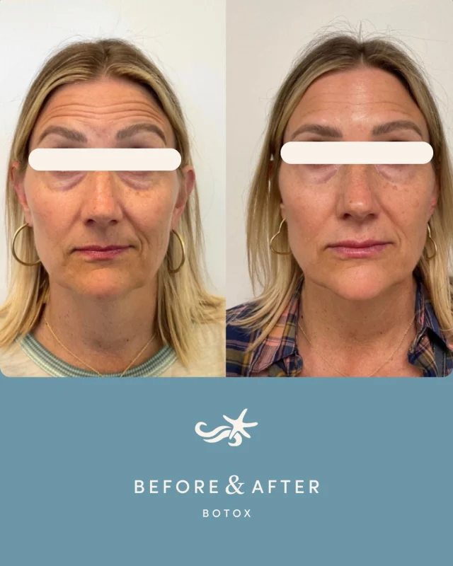 ✨ Refreshed, natural, and effortlessly you. ✨

These results are from a single Botox treatment — softened lines, smoother skin, and that well-rested look that turns heads for all the right reasons.
 
Our injectors take the time to understand your unique facial anatomy, using precise placement and personalized dosing so your results move naturally with you.

New patients receive $10/unit Botox pricing for a limited time 💉 
Book at the link in bio!