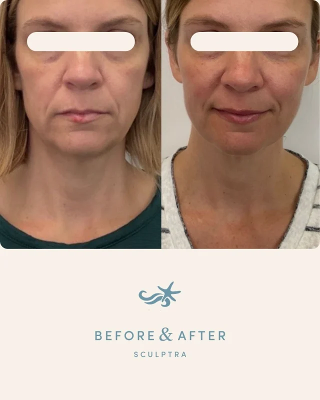 Sculptra works differently than traditional filler.

Instead of adding immediate volume, it stimulates your body’s own collagen production over time, gradually restoring structure, firmness, and fullness.

The result is subtle, natural, and long-lasting.

This is your skin, just supported 🤍 Book yours at the link in bio.