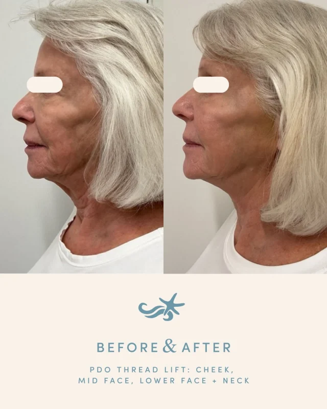 A beautiful, natural refresh🤍👏🏼

This 74-year-old patient wanted to address laxity in the neck and jowls. Anna performed a PDO thread lift to the cheeks, mid face, lower face, and neck to restore support and create a more lifted appearance. 

PDO threads work by lifting and stimulating collagen — for results that continue to improve over time.

The result? A softer, lifted, more youthful look, without surgery 💉

Curious if threads are for you? Book at one of our locations in La Jolla, Otay Ranch, Temecula, or Carlsbad!