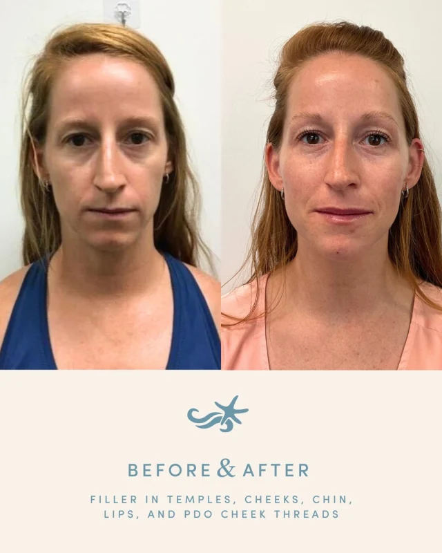 A true example of full-face balancing ✨

This result was achieved by @thecaliforniainjector with a thoughtful combination of treatments, including Voluma to the temples, cheeks, and chin, Volbella to the lips, and PDO cheek threads — all designed to enhance structure while maintaining a natural, balanced look.

This Mother’s Day, you can enjoy a full-face refresh: Purchase 2 syringes of filler and receive 20 units of tox on us!

Valid May 4–9, book this week at the link in bio!

.

[ San Diego Medspa, Best of San Diego, San Diego Aesthetician, Medspa, Skin Clinic, San Diego Facial, La Jolla Cosmetic Medical Spa, Before and After, Injectables, San Diego Injector, Filler Results, Facial Filler, PDO Threads]
