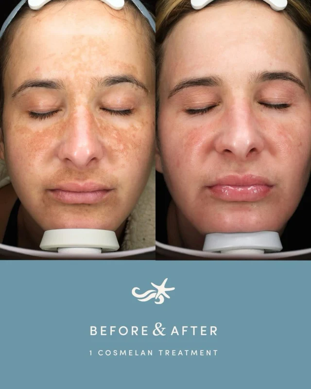 This patient was treated by @skinlikecameron with 1 Cosmelan treatment to target melasma and stubborn pigmentation.

Cosmelan is a medical-grade depigmentation treatment designed to: • Reduce melasma + hyperpigmentation • Brighten and even overall skin tone • Improve skin texture and radiance

Real results, after just one treatment.

Don’t just cover it, correct it. Book at the link in bio!

.

[ San Diego Medspa, Best of San Diego, San Diego Aesthetician, Medspa, Skin Clinic, San Diego Facial, La Jolla Cosmetic Medical Spa, Cosmelan Treatment, Pigment Treatment, Before and After, Medical Grade Skincare ]