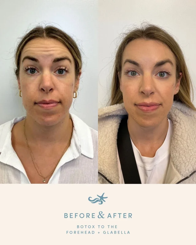 A smoother, more refreshed look… without losing expression ☁️

This patient was treated in the forehead + glabella to soften fine lines and prevent deeper creasing, while keeping everything natural and balanced.

Results like this typically settle in within 10–14 days.

Book your appointment at one of our many locations in La Jolla, Otay Ranch, Temecula, or Carlsbad! 🤍

.
[ San Diego Medspa, Best of San Diego, San Diego Aesthetician, Medspa, Skin Clinic, San Diego Injector, La Jolla Cosmetic Medical Spa, Anti Aging, Skin Tips, Hydrated Skin, Botox, Daxxify, Dysport, Injectables, Before and After, Medical Grade Skincare]