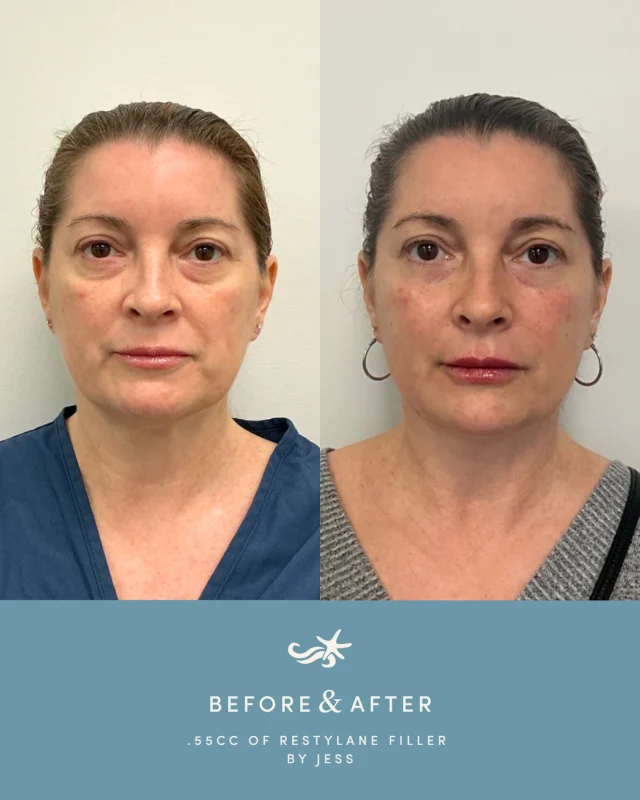 This before and after was achieved with .55cc of Restylane filler by @jesskousky, designed to improve hollowness, and create a brighter, more rested look while still maintaining natural facial movement and balance💉✨

Interested in facial filler or not sure where to start? We would love to create a personalized treatment plan based on your goals. 

Visit the link in bio to learn more or book your consultation!