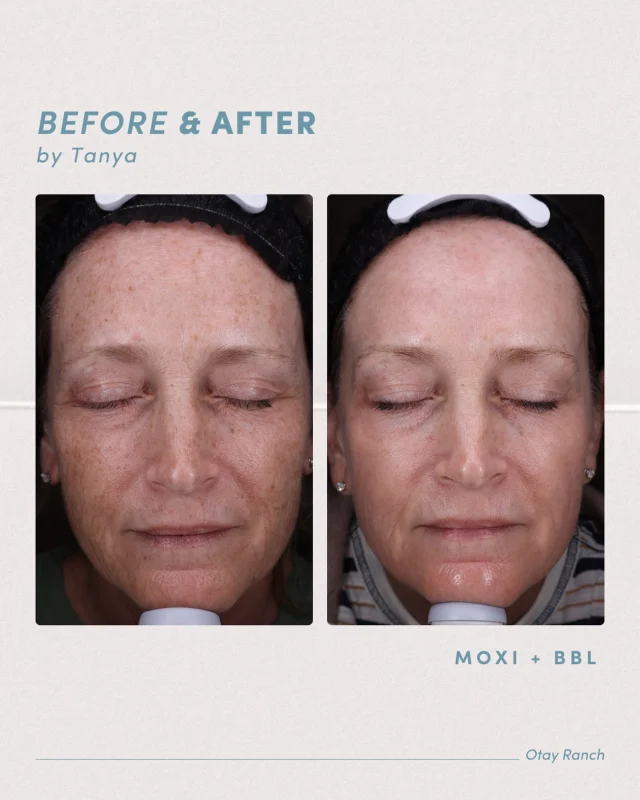 This before and after by @tanyaaguilarxo, features a customized combo of BBL + Moxi laser, designed to target sun damage, redness, uneven tone, and texture, revealing clearer, brighter, more radiant skin with little downtime 🌤️

Interested in BBL, Moxi, or not sure where to start? We would love to create a personalized treatment plan based on your goals. Visit the link in bio to learn more or book your consultation!

.
[ San Diego Medspa, Best of San Diego, San Diego Aesthetician, Medspa, Skin Clinic, San Diego Laser, BBL Laser, Moxi Laser, BBL Before and After, Moxi Before and After, Laser Treatment Results, Radiant Skin, Clearer Skin, Sun Damage Treatment ]