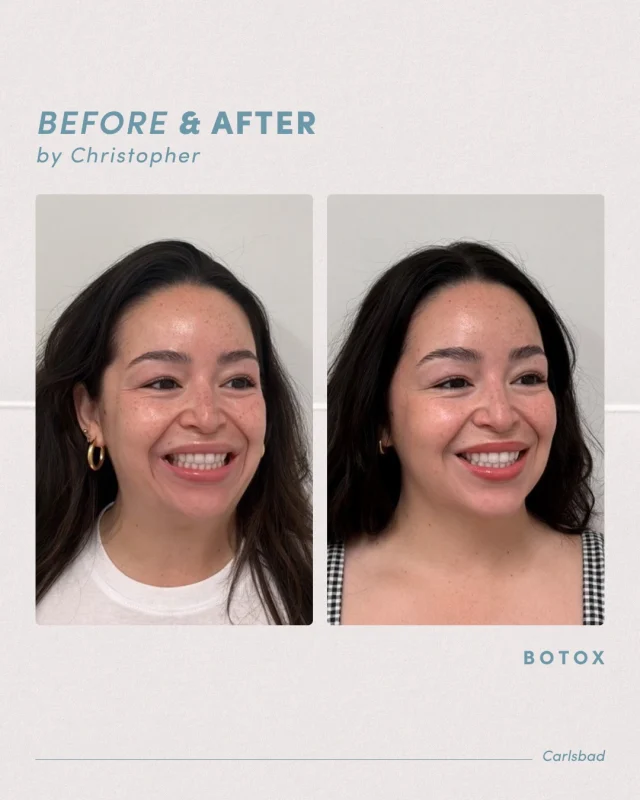 Natural, refreshed, and still you💉

This is what a little Botox can do — and the results speak for themselves. Right now, new patients can receive Botox at $10/unit for a limited time.

Book your appointment at one of our many locations in La Jolla, Otay Ranch, Temecula, or Carlsbad! 🤍

.
[ San Diego Medspa, Best of San Diego, San Diego Aesthetician, Medspa, Skin Clinic, La Jolla Cosmetic Medical Spa, Botox, Daxxify, Dysport, Injectables, Botox promo, Before and After, Injectables ]
